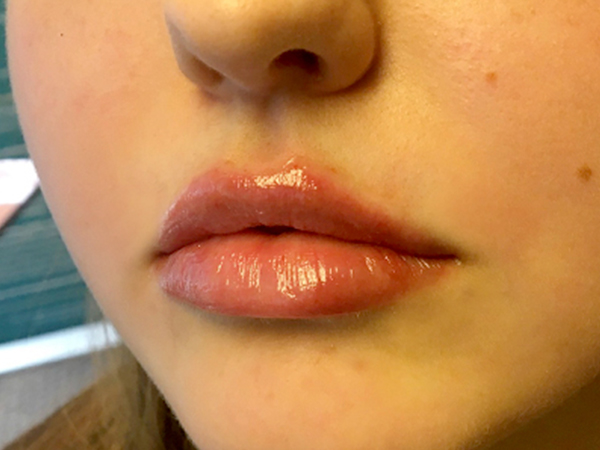 Injectables And Fillers 03