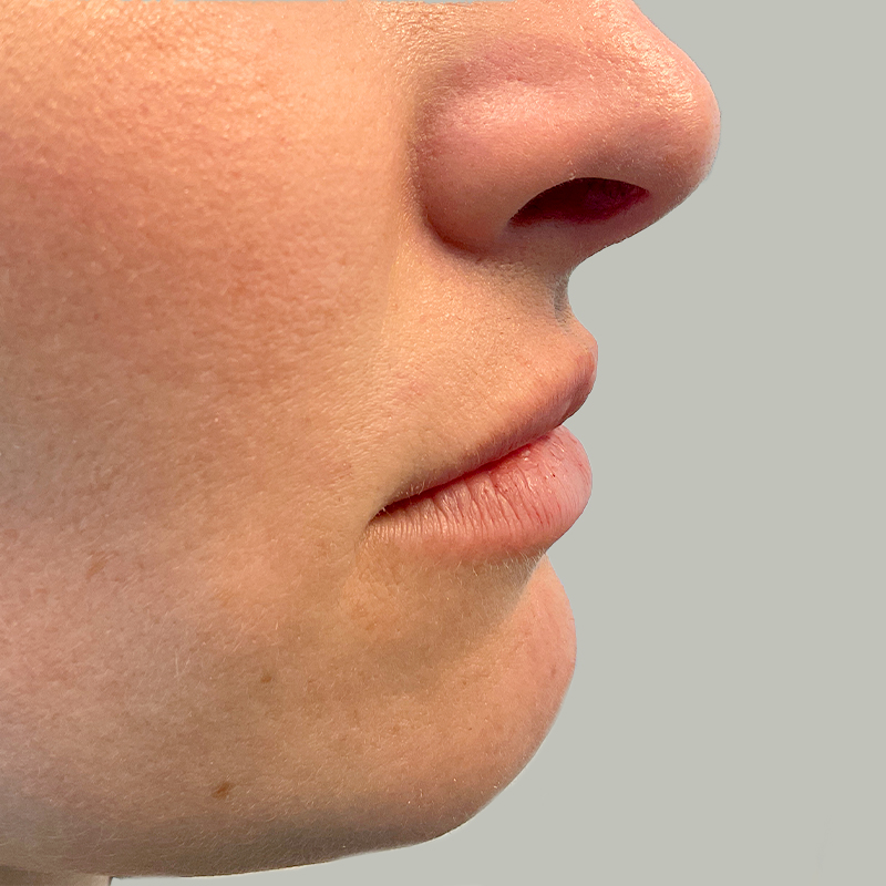 Injectables And Fillers 01