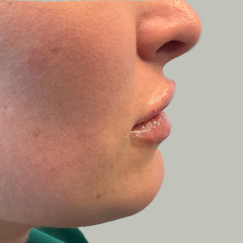 Injectables And Fillers 16