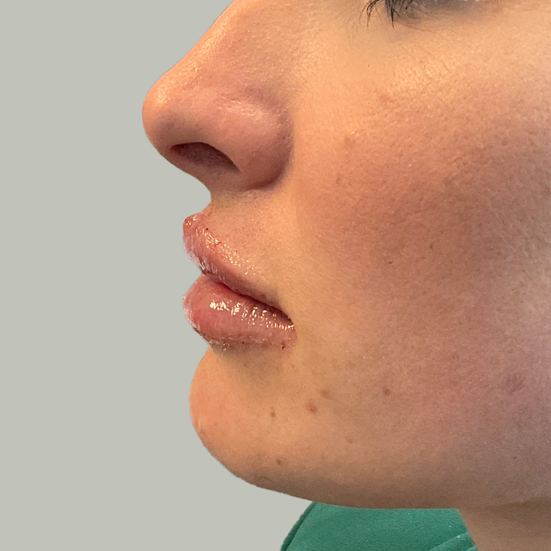 Injectables And Fillers 05