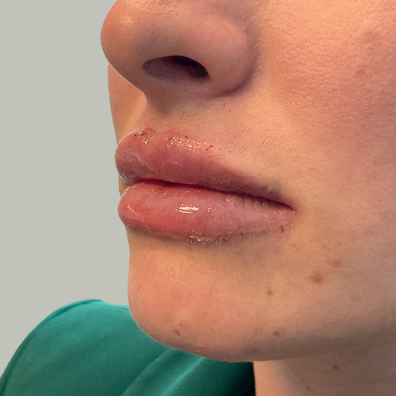 Injectables And Fillers 07