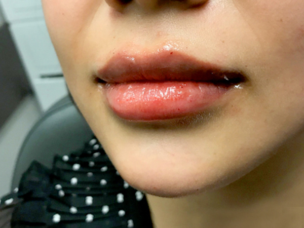 Injectables And Fillers 03