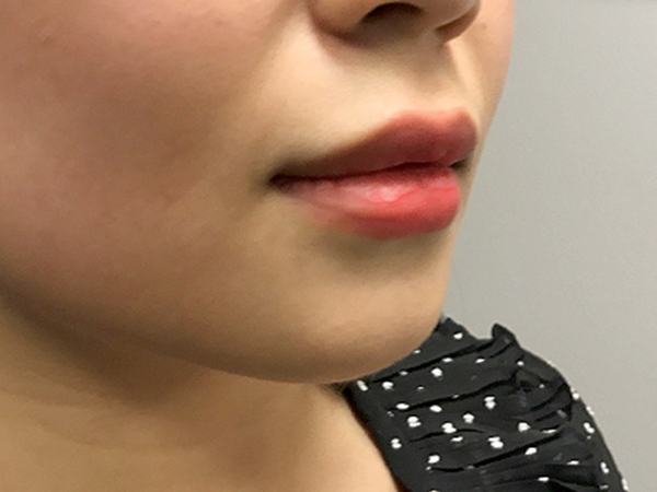 Injectables And Fillers 05