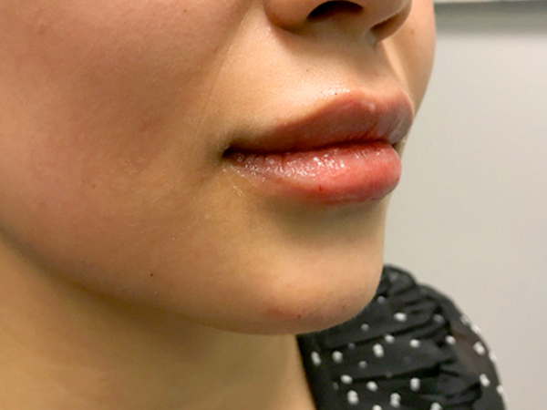 Injectables And Fillers 05