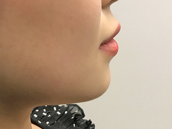 Injectables And Fillers 07