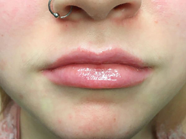 Injectables And Fillers 161