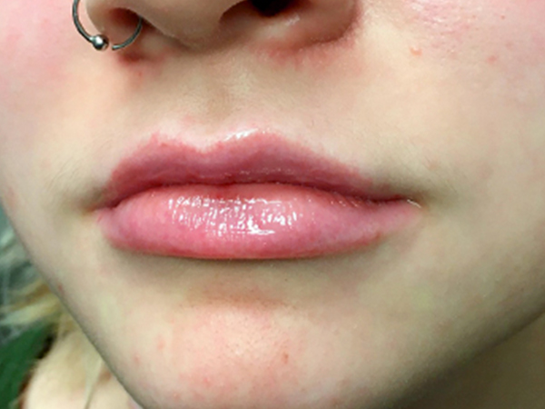 Injectables And Fillers 03