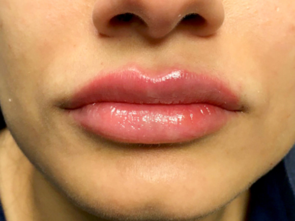 Injectables And Fillers 163