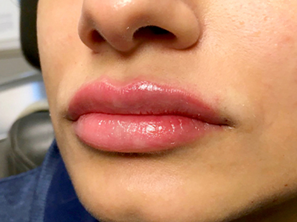 Injectables And Fillers 03