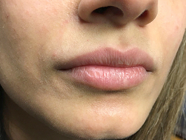 Injectables And Fillers 05