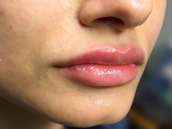 Injectables And Fillers 05