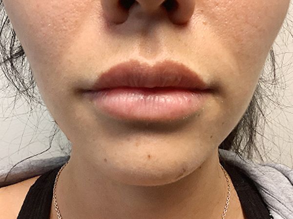 Injectables And Fillers 01