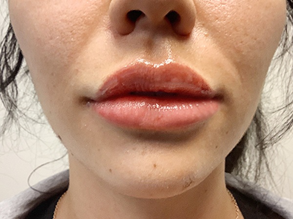 Injectables And Fillers 164