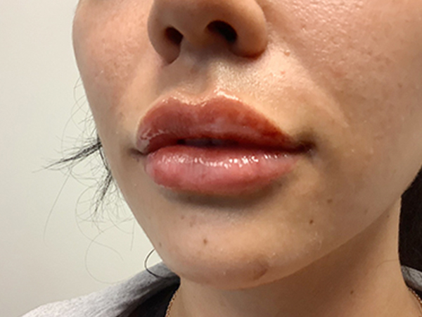 Injectables And Fillers 03