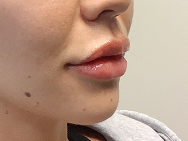 Injectables And Fillers 05