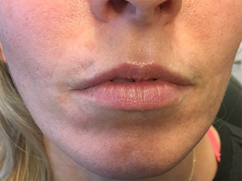 Injectables And Fillers 01