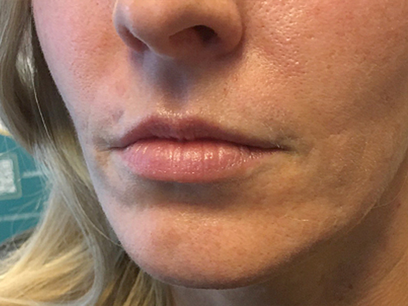 Injectables And Fillers 03