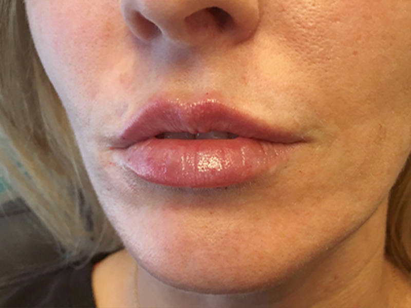 Injectables And Fillers 03