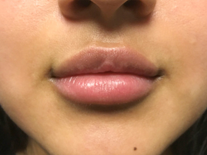 Injectables And Fillers 01