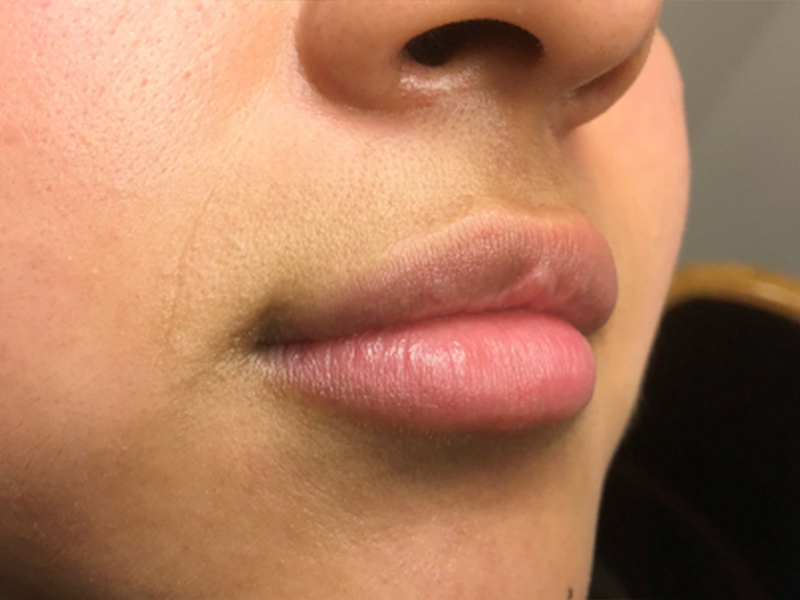 Injectables And Fillers 03