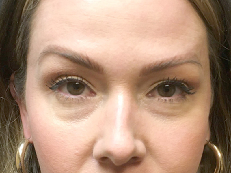 Injectables And Fillers 01