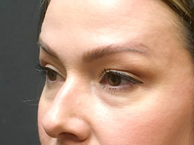 Injectables And Fillers 03