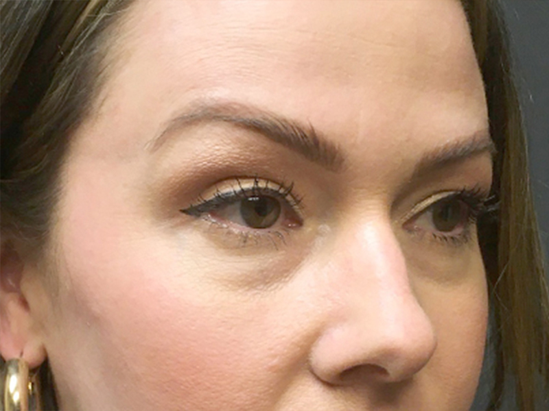 Injectables And Fillers 05