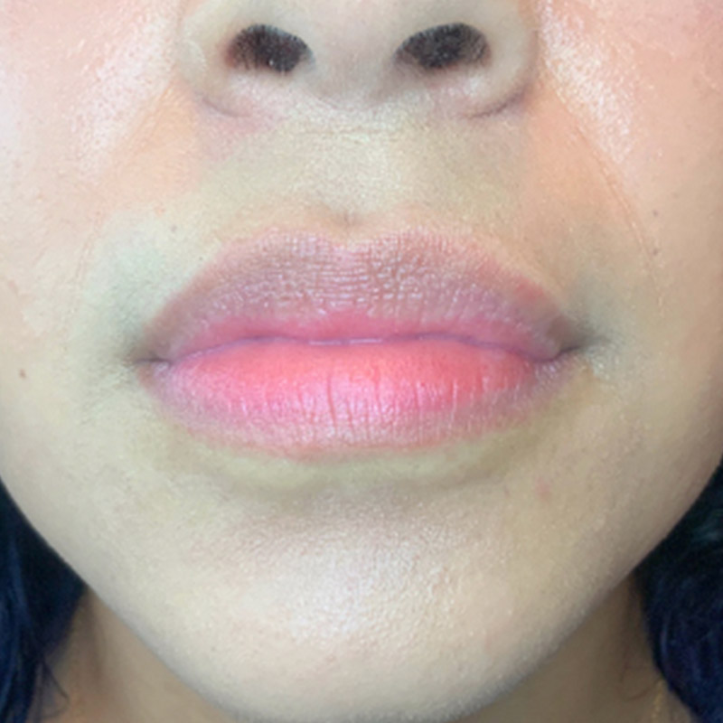 Injectables And Fillers 01