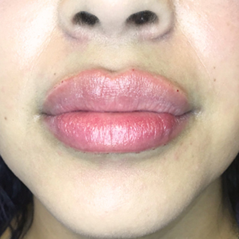 Injectables And Fillers 168