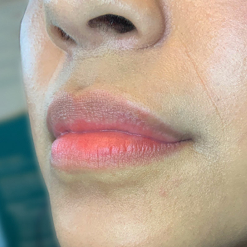 Injectables And Fillers 03