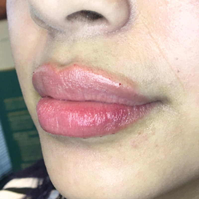 Injectables And Fillers 03