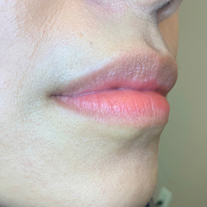 Injectables And Fillers 05