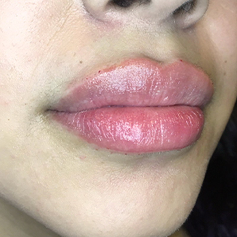 Injectables And Fillers 05