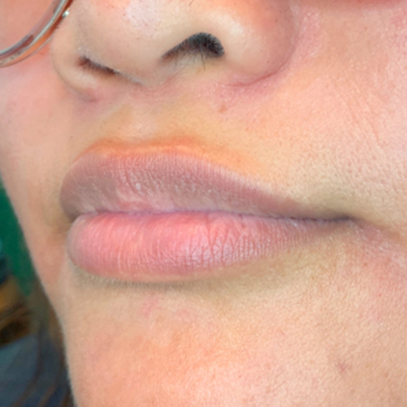 Injectables And Fillers 03