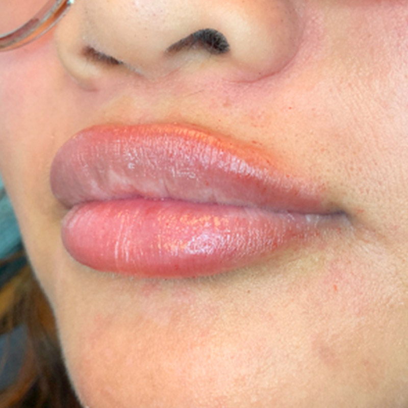 Injectables And Fillers 03