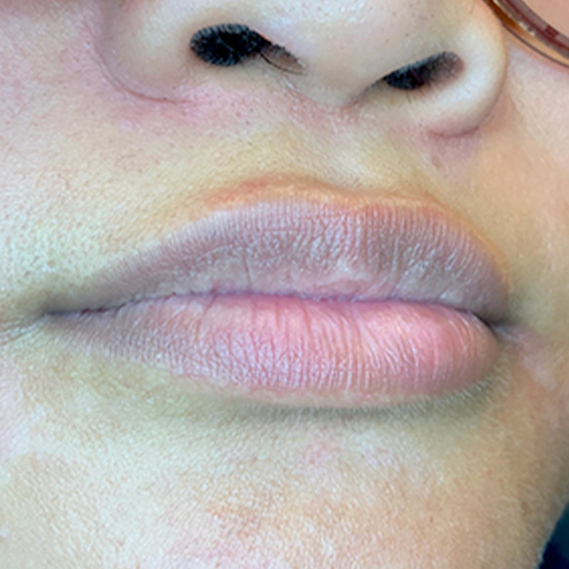 Injectables And Fillers 05