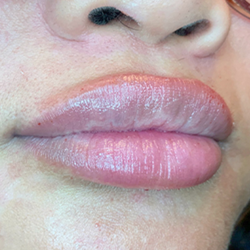 Injectables And Fillers 05