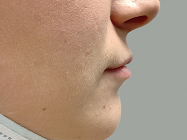 Injectables And Fillers 03