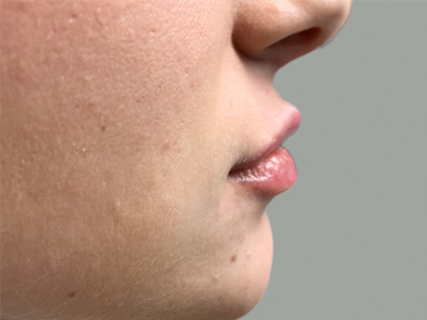 Injectables And Fillers 03