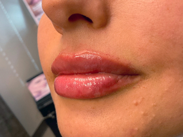 Injectables And Fillers 03