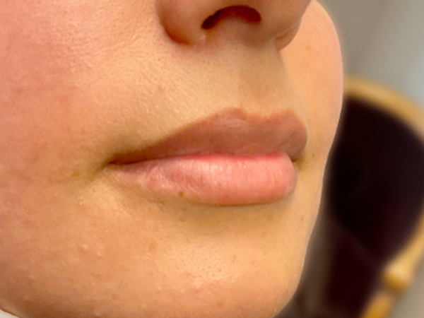 Injectables And Fillers 05