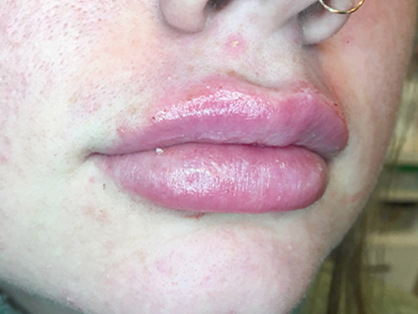 Injectables And Fillers 05