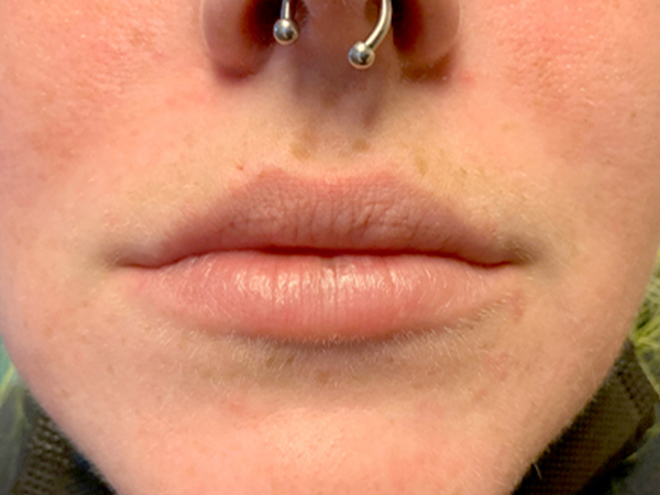 Injectables And Fillers 01