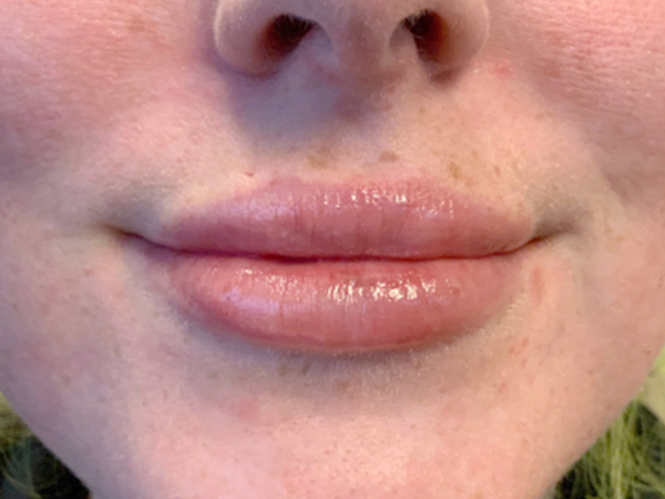 Injectables And Fillers 172