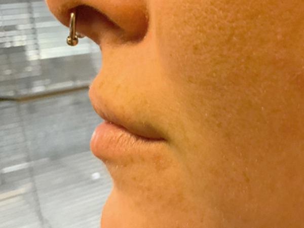 Injectables And Fillers 03