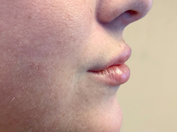 Injectables And Fillers 05