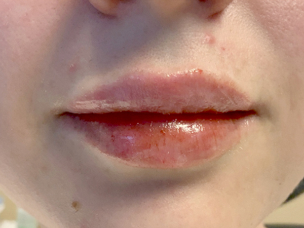 Injectables And Fillers 174