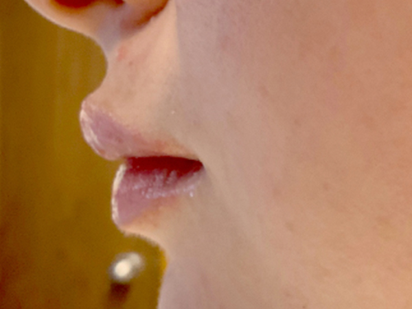 Injectables And Fillers 03