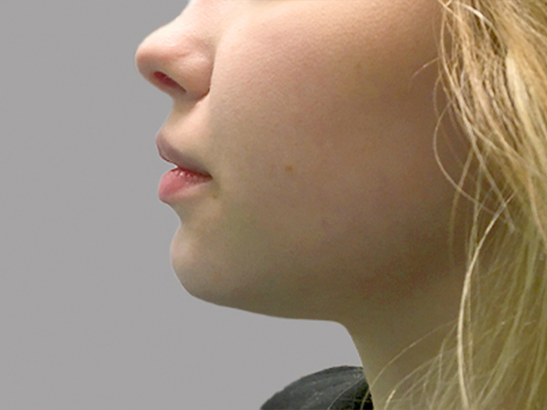 Injectables And Fillers 175