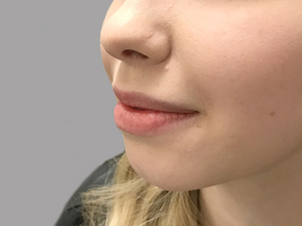 Injectables And Fillers 03